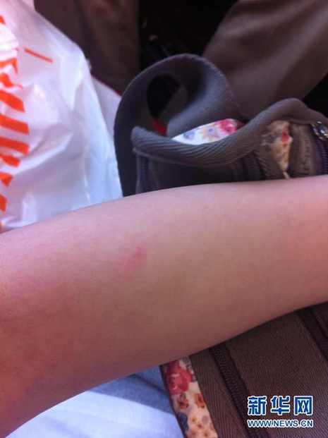 索尼RX100驚現“夾肉事件” 玩相機也流血？