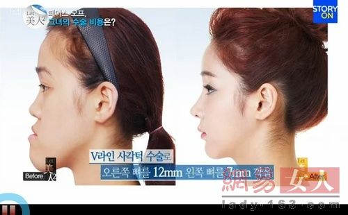 丑女變靚妹！韓國整容節目爆紅