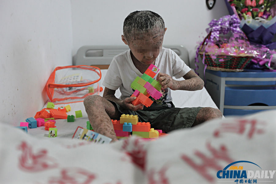 “樹皮娃娃”后續:多位專家為杭杭會診