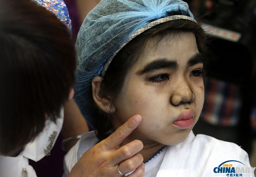 杭州：10歲輟學“毛孩”受關愛 接受面部激光脫毛