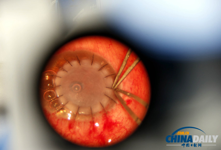 失明患者獲異國角膜“點(diǎn)亮”右眼 捐贈者車禍過世