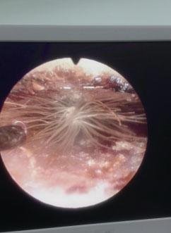 1歲女童耳朵飄進花種 4個月后耳中長蒲公英(圖)