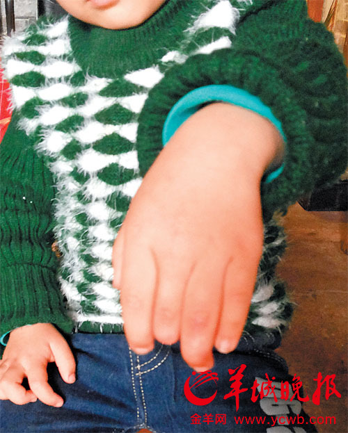 佛山兩歲童醫(yī)院慘斷指 欲上訴病歷竟被扣