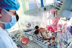 重慶22專家會診雙頭女嬰認定屬單體 仍未脫離危險