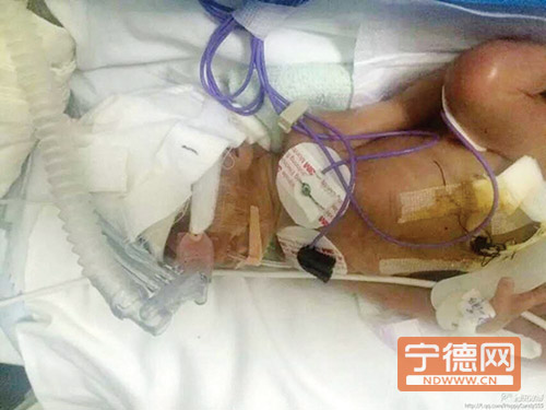 福鼎產婦26周早產雙胞胎女嬰 兩女嬰總體重不足3斤