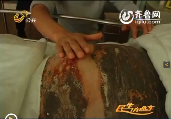濰坊24歲準(zhǔn)媽媽全身90%燒傷 丈夫婆婆離世為愛堅強保胎