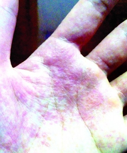 女白領一夜之間全身長泡 工作壓力大螨蟲入侵