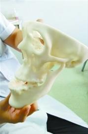 患罕見“長臉癥” 大二男孩不再自卑手術(shù)整形