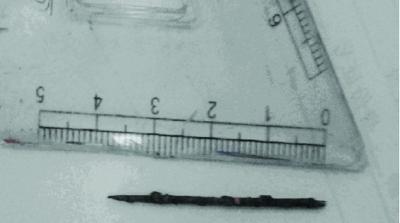 產(chǎn)婦幼時玩耍誤吞繡花針 游走體內(nèi)20年停子宮壁