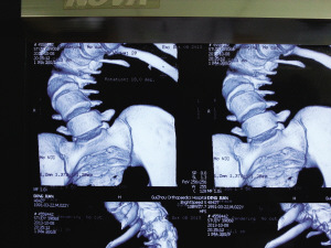 小伙患病身高僅1.26米 手術(shù)后“長高”12公分(圖)