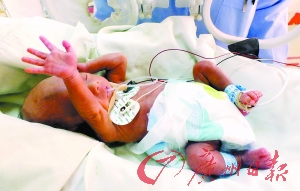 廣東“巴掌寶寶”出生時(shí)僅920克(圖)