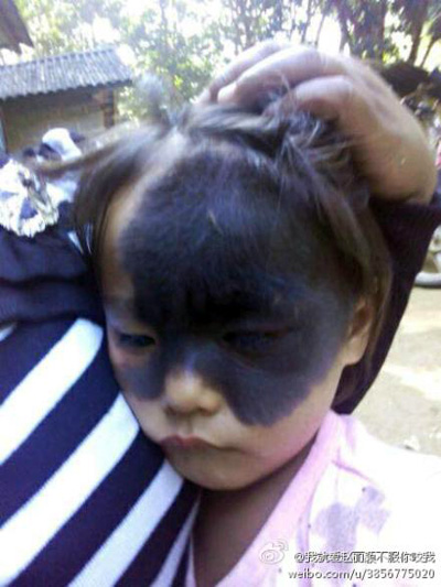 云南孟連“面具女孩”黑斑遮住半張臉 網上求助（圖）