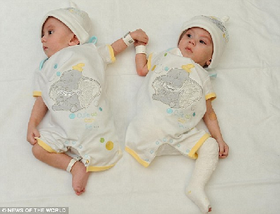 愛爾蘭連體雙胞胎成功分離 手牽手亮相溫馨感人