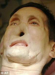 美國第二位“換臉”人術后現身 對新生活充滿希冀