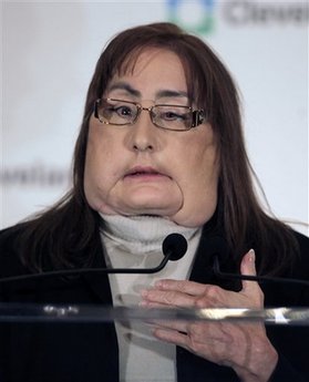 美國首例“全臉移植”患者術后首度展示“新臉”