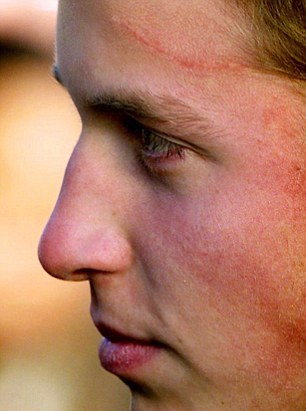 英王妃凱特曾做腦部手術？ 近8厘米傷疤清晰可見