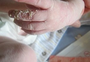 英國(guó)新生兒患罕見(jiàn)怪病 一碰皮膚就長(zhǎng)水皰無(wú)法被擁抱