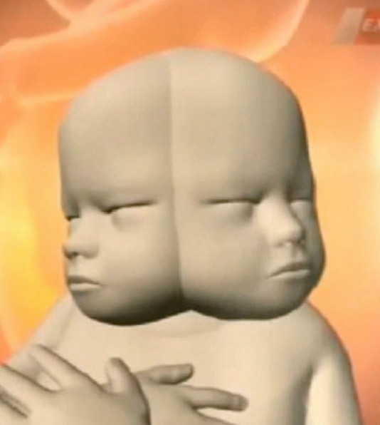 澳大利亞女子拒絕流產 將生下罕見“雙面”女嬰