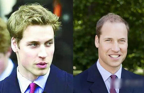 為什么男性禿頭都禿成一個樣？心疼男神們的發際線